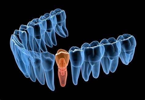 Chipped Tooth: What to Do Right Away