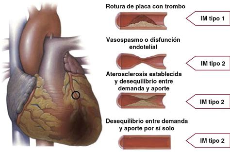 Infarto In English