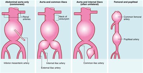 Aneurysms and Other Peripheral Arterial Disorders - Clinical Tree