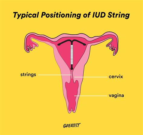 Look How Do Iud Strings