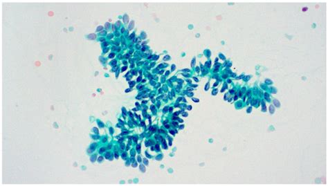 Diagnosis of Low-Grade Urothelial Neoplasm in the Era of the Second ...