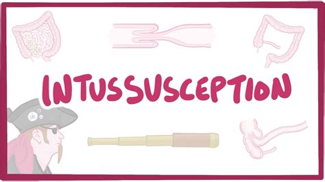 Image result for Definition of Intussusception