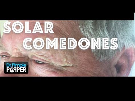 Image result for Solar Comedones Extraction