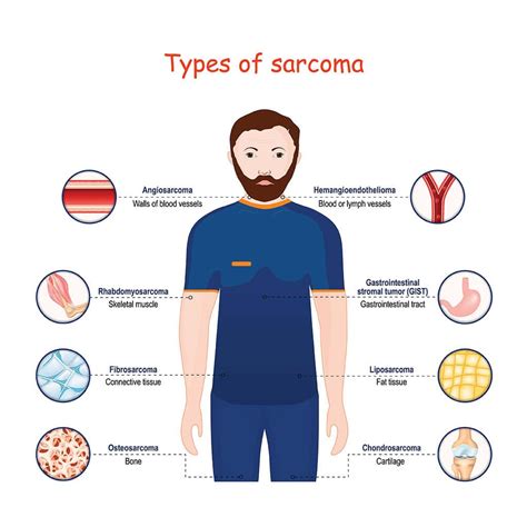 All You Need to Know About Sarcoma - CK Birla Hospital
