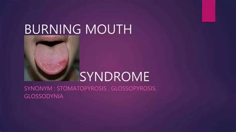 Burning Sensation Of The Tongue: Burning Mouth Syndrome – RKIF
