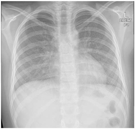 A Rare Pediatric Case of Severe Bird Fancier’s Lung Presented with ...
