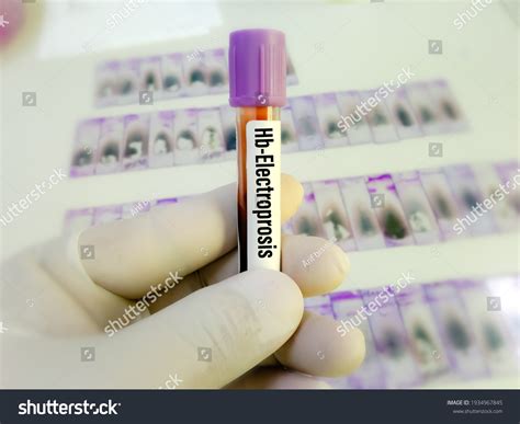 971 Tests Lymphoma Images, Stock Photos & Vectors | Shutterstock