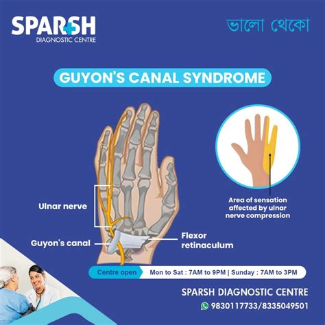 Guyon’s Canal Syndrome: Causes, Symptoms, Diagnosis, and Treatment ...