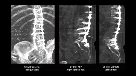 SPECT/CT imaging in the evaluation of pain following spinal fusion surgery - Siemens ...