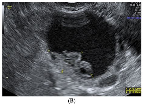 Ultrasound Features and Ultrasound Scores in the Differentiation ...