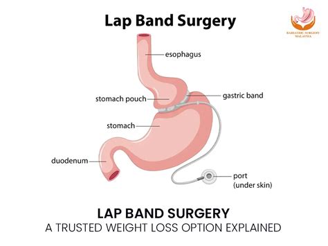 Image result for Lab Band Surgery Risks