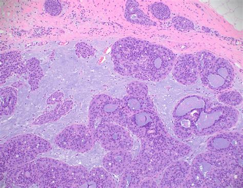 Pathology Outlines - Atypical lobular hyperplasia