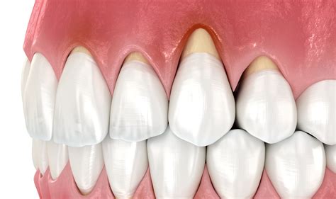 How to Recognize Early Signs of Gum Recession | Cromwell Dentists | Fedorciw & Massoumi LLC