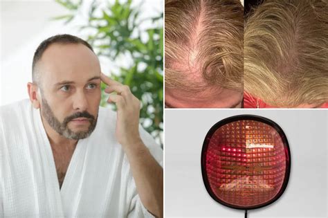 Does red ligh therapy for hair loss really work? - Fashnfly
