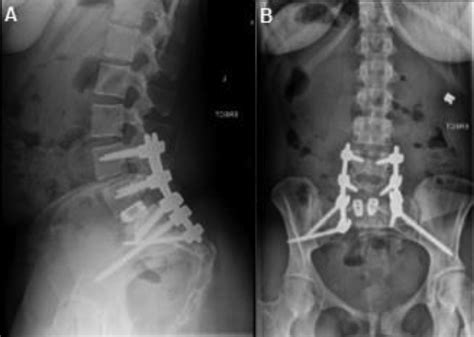 Complex surgical reconstruction for spinopelvic instability caused by a giant Tarlov cyst ...