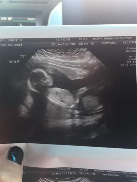 18 Weeks Pregnant with Twins: Tips, Advice & How to Prep | Twiniversity ...