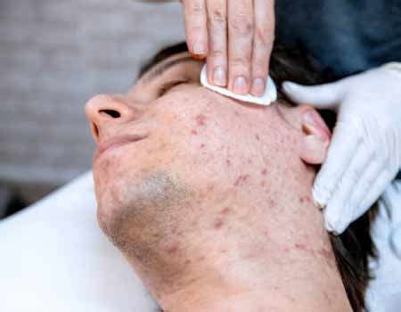 Acne Treatment in Vijayawada | Best Skin Acne Clinic in Vijayawada ...