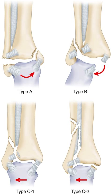 Fractures of the Lower Extremity - Clinical Tree