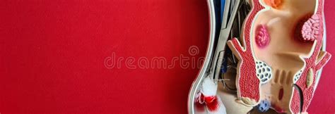 Image result for Loop Colonoscopy