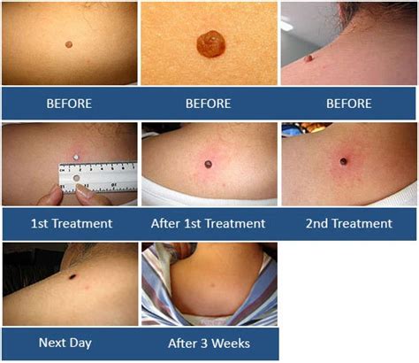 Pristine herbal touch Mole Remover, Wart Remover, Skin Tag remover ...