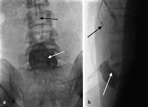Superior Hypogastric Nerve Block for Pain Control after Uterine Artery ...