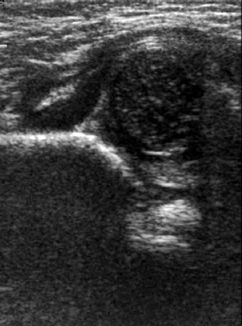 How to Perform Hip Ultrasound 的图像结果