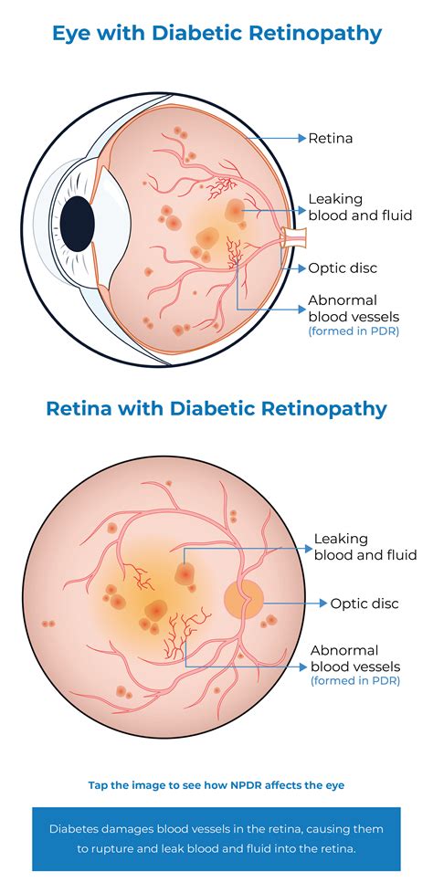 DR - Diabetic Retinopathy - Kodiak Sciences