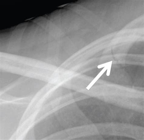 X Ray Broken Ribs