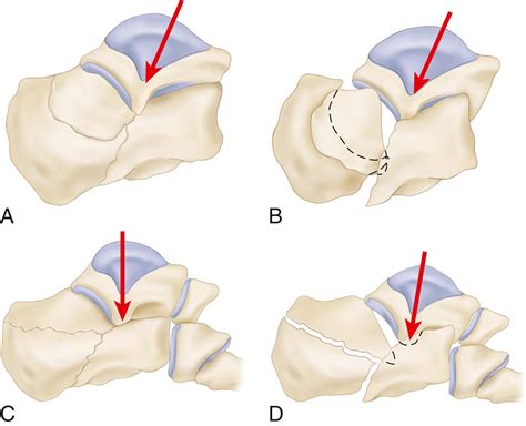Fractures and Dislocations of the Foot - Clinical Tree