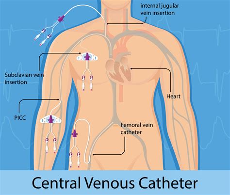 Central Venous Catheter Subclavian