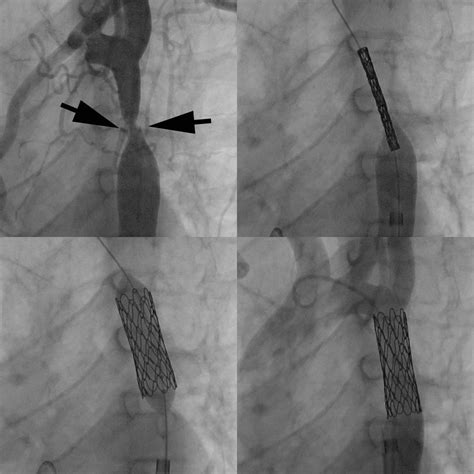 Cardiac Catheterization