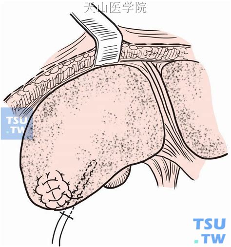 【附图】 肝部分切除术 _外科手术学 | 天山医学院