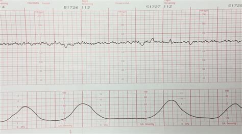 Image result for Absent Variability
