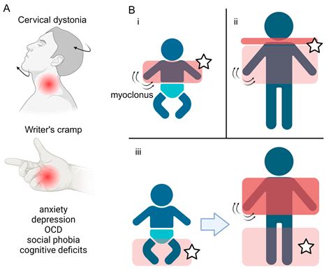 Myoclonus: Hiểu Biết Toàn Diện về Co Giật Cơ và Cách Điều Trị