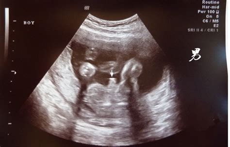 怀孕3个月。B超检查2个半月。胎儿猜5.8厘米。说是偏小、 谁能给我解释下、还有怎么才能使胎儿正常了?_百度宝宝知道-请妇产科专家解释14周 ...