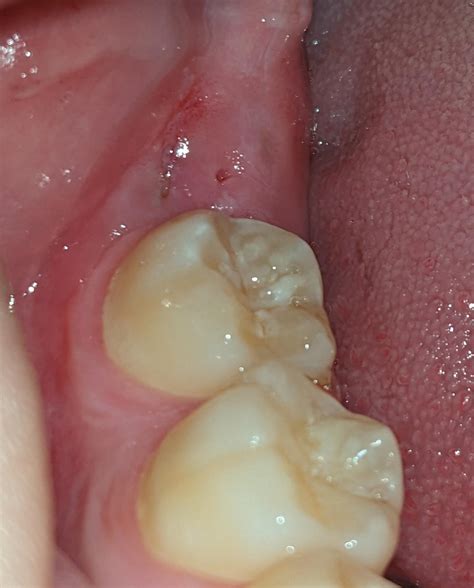 19M—Bottom left wisdom tooth erupting. Seems to have enough space, but gum is of course ...