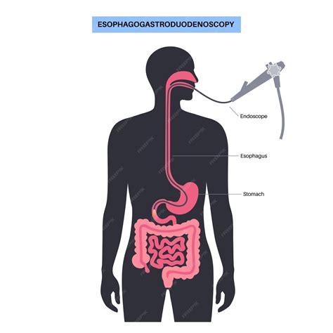 Esophagogastroduodenoscopy medical poster diagnostic endoscopic ...