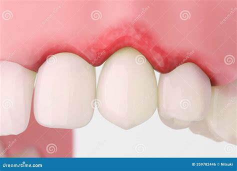 Tooth Recession 的图像结果