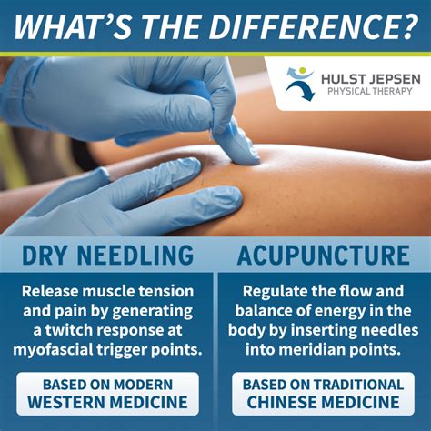 Unlocking the Benefits of Dry Needling and Acupuncture at Physio Labs ...