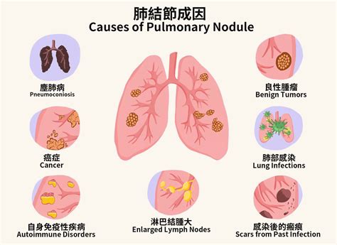 Lung Nodule | HEAL Medical | Respiratory Medicine | Cardio Thoracic Surgery