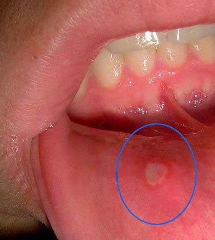 Kuvatulokset haulle blister on inner lip of mouth