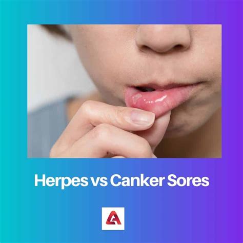 Abscess Vs Canker Sore at Eugene Bergeron blog