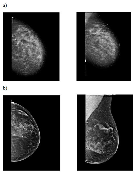 Inferior Pedicle Reduction Mammoplasty as Corrective Surgery after ...