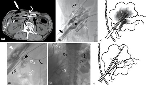 Image result for Exploding Belly Abcess