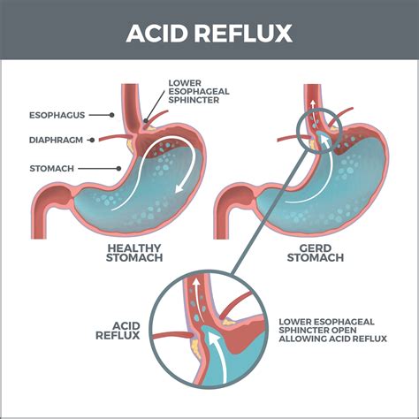Gastroesophageal Reflux Disease -Overview Causes, Symptoms, and Risk ...