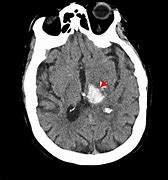 Image result for cerebral hemorrhage