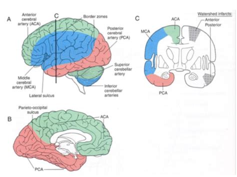 Image result for Contralateral Brain Injury