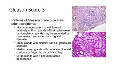 Gleason Score perhitungan untuk cancer prostat | PPTX