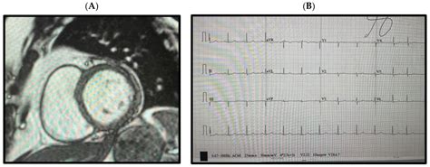 A Single Nucleotide Variant in Ankyrin-2 Influencing Ventricular ...