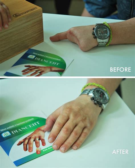 How to Use a Hand Prosthesis 的图像结果